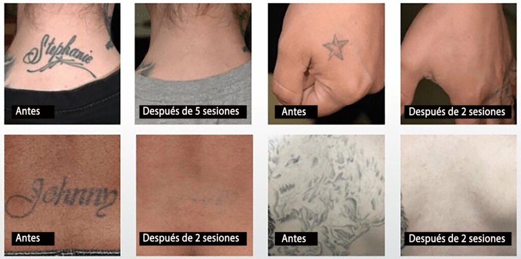 Eliminación de tattoo