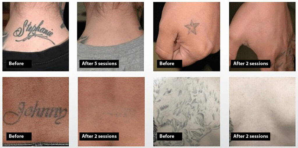 Antes y después de sesión para quitar tatuajes